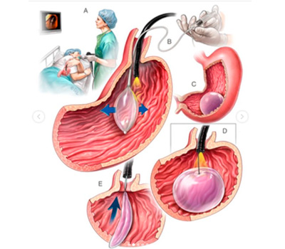 Balón Intragástrico